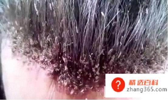 头上长虱子怎么去除(去除头上长虱子的情况可以采用多种方式)