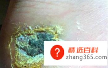 伤口有点化脓怎么办(伤口化脓怎么处理比较好)