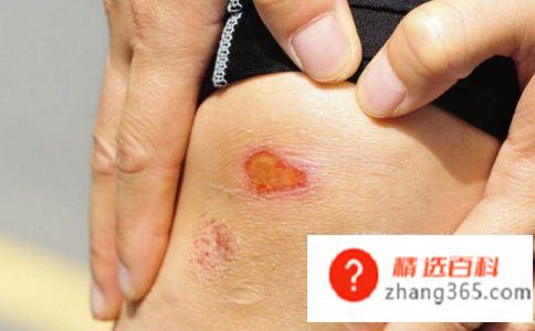伤口有点化脓怎么办(伤口化脓怎么处理比较好)