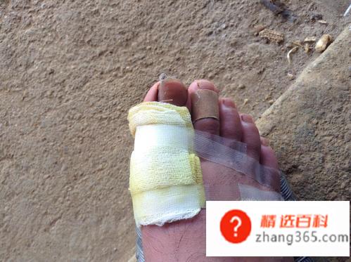 伤口有点化脓怎么办(伤口化脓怎么处理比较好)