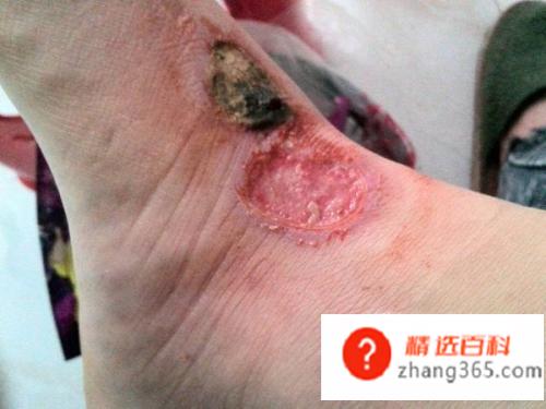 伤口有点化脓怎么办(伤口化脓怎么处理比较好)