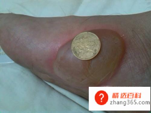 伤口有点化脓怎么办(伤口化脓怎么处理比较好)